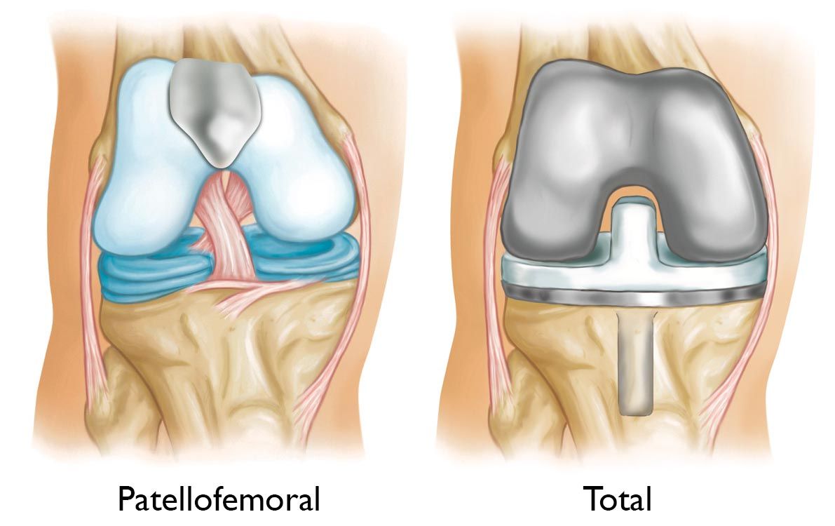 Patellofemoral replacement and total knee replacement