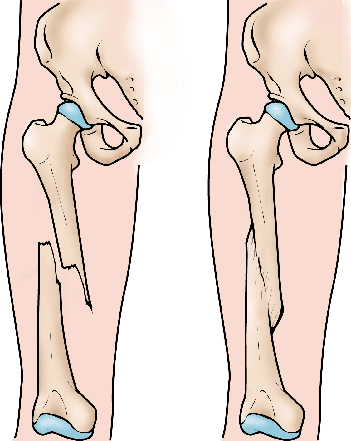 Femur (thighbone) fracture remodeling