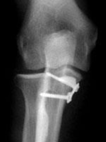 elbow fracture plate-and-screw fixation