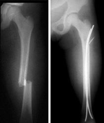 Femur (thighbone) fracture before and after treatment with intramedullary nail