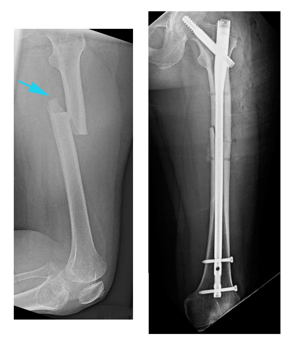 X-rays of transverse fracture and intramedullary nailing
