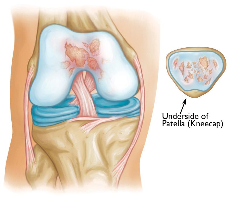 Osteoarthritis in the patellofemoral compartment of the knee