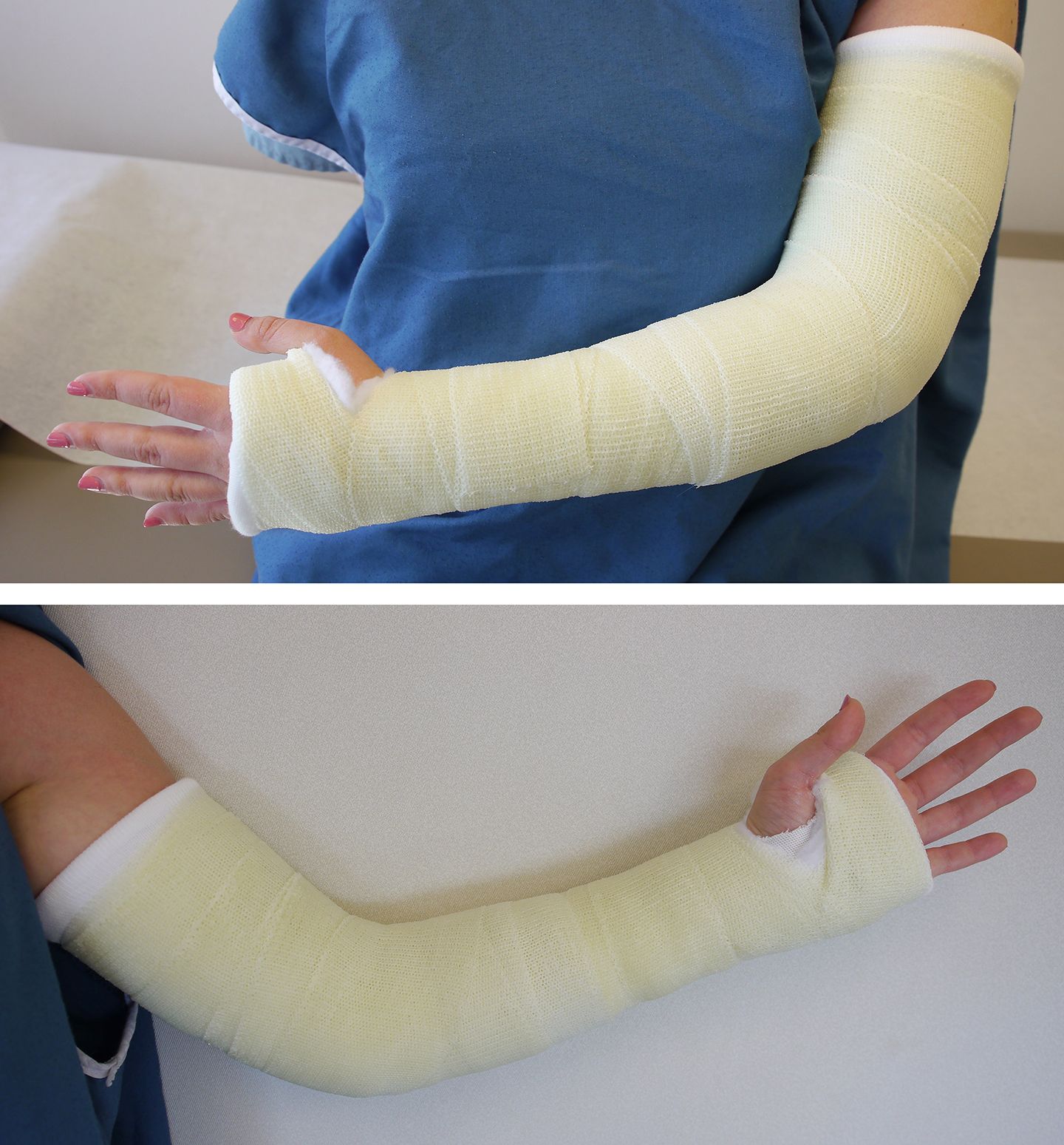 long arm cast