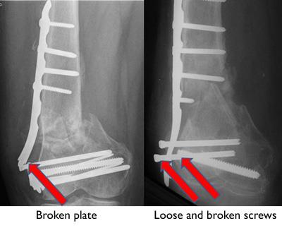 Broken plate and screws in a poorly healing distal femur fracture