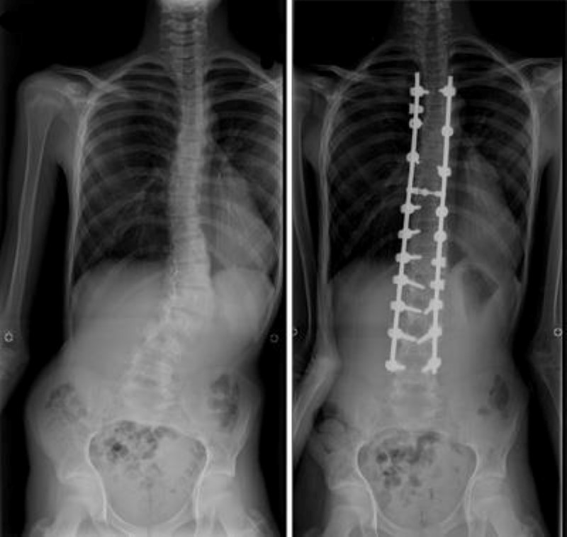x-rays of scoliosis and spinal fusion