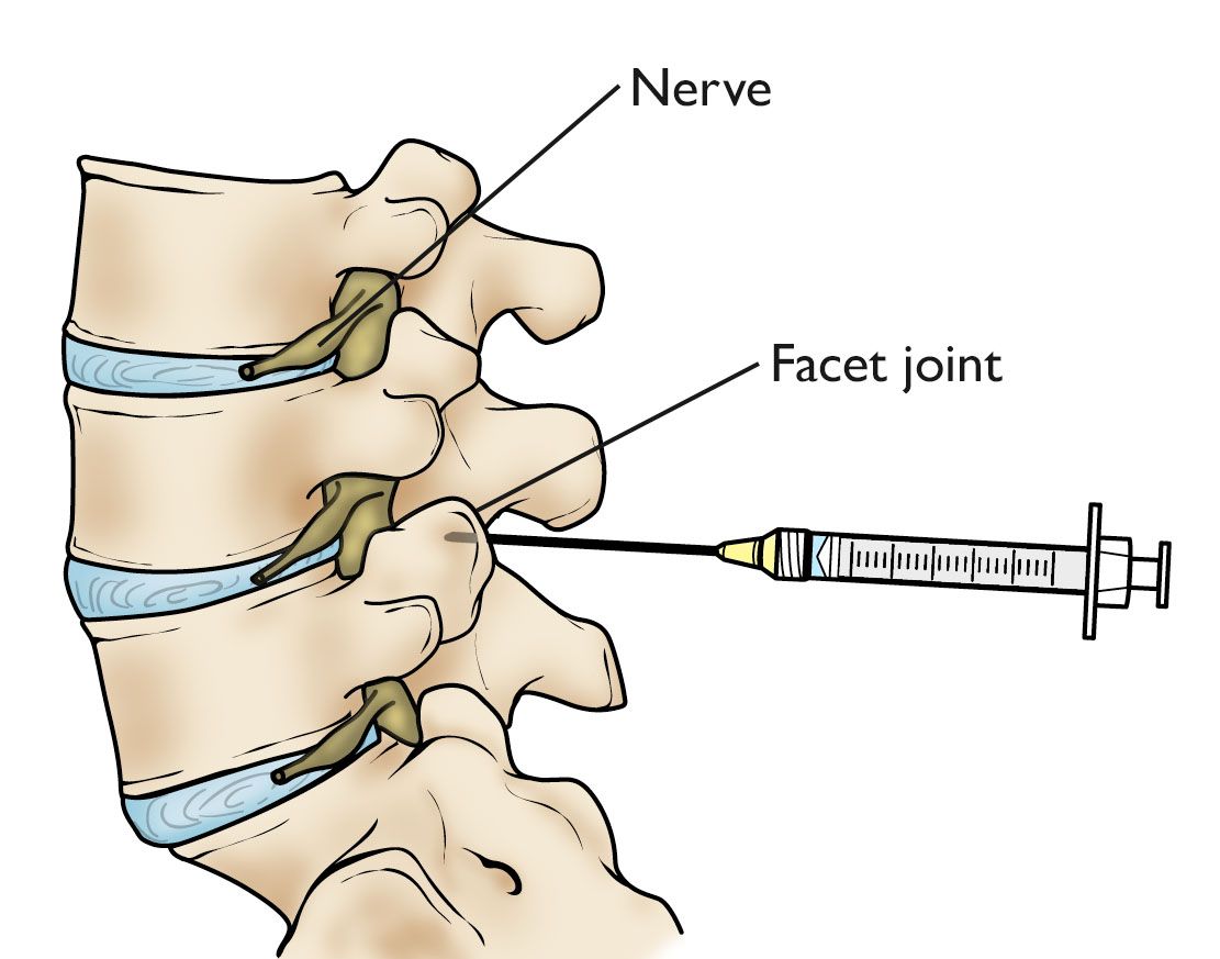 Facet joint injection in the lumbar spine