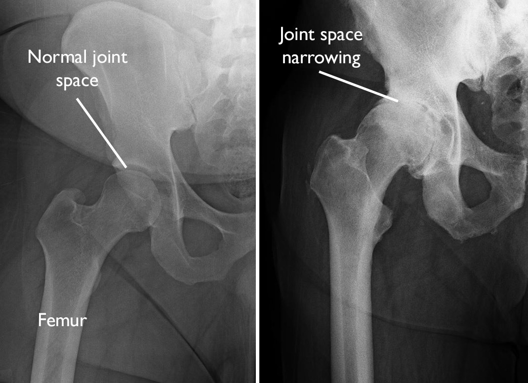 Normal and Arthritic Hip X-rays