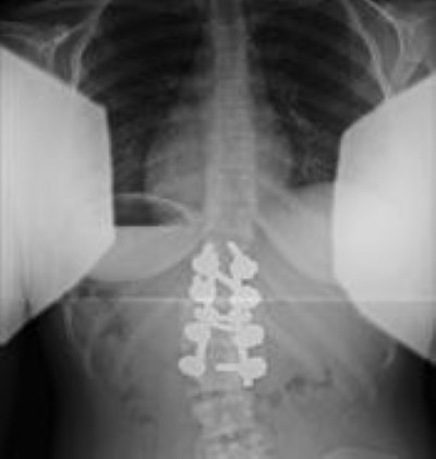 postoperative x-ray of congenital scoliosis