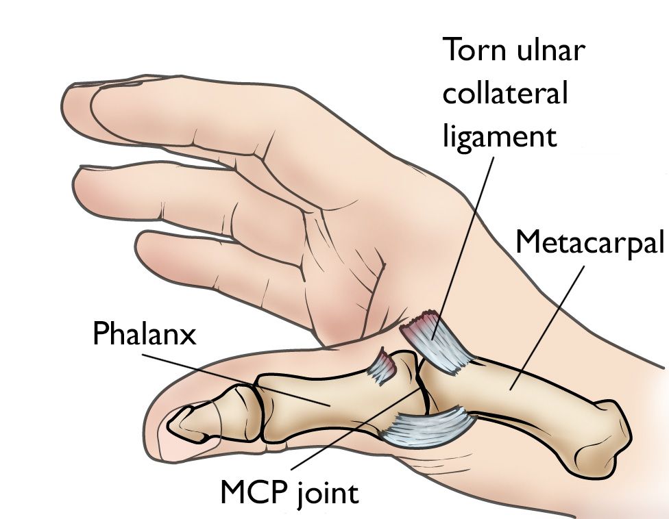 Torn ulnar collateral ligament
