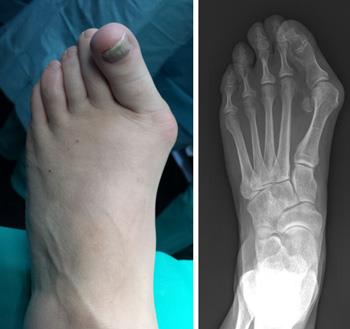Photo and x-ray of foot deformed by a bunion