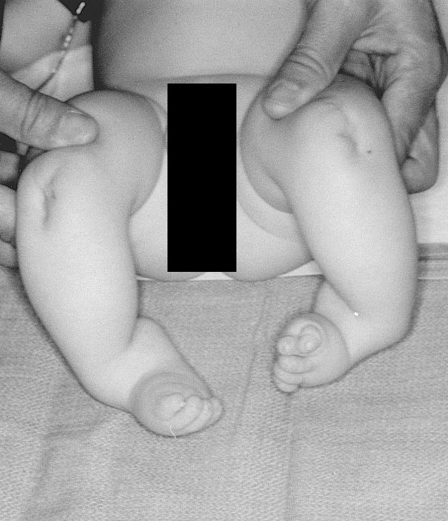 Baby with tibial hemimelia