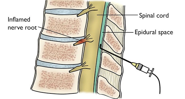 Illustration of an epidural injection in the cervical spine. 