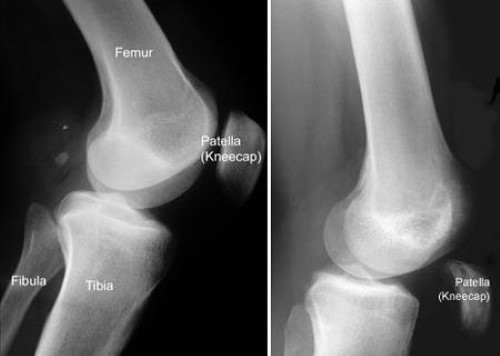 x-ray of quadriceps tendon tear