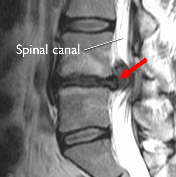 MRI of herniated disk