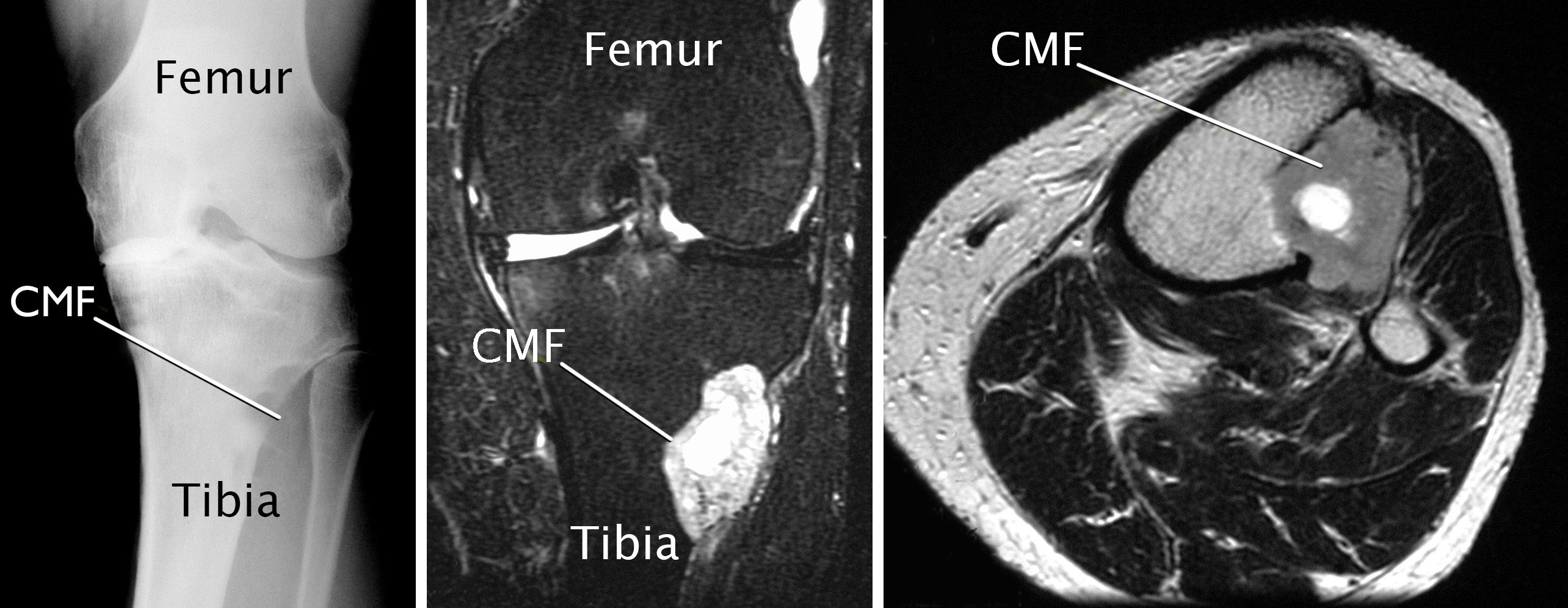 imaging scans of chondromyxoid fibroma