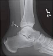 Calcification within Achilles tendinitis