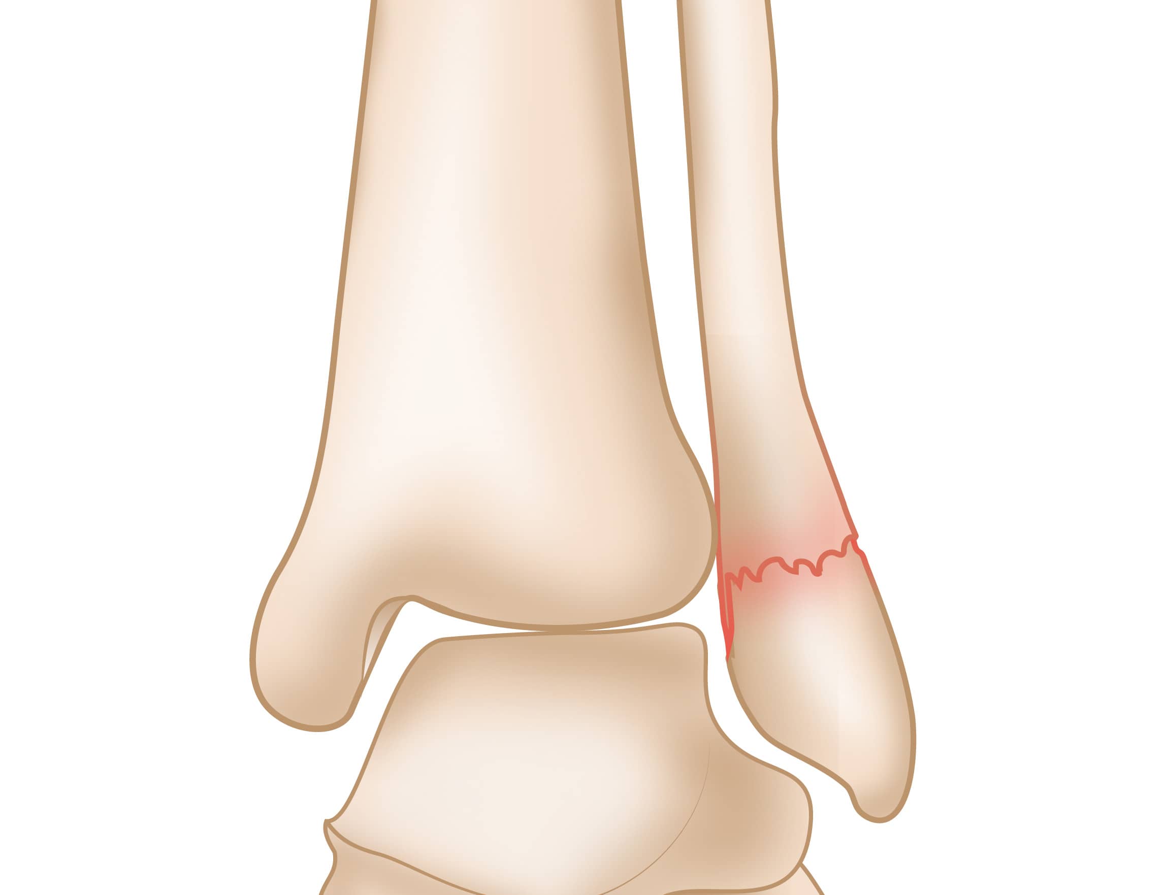 Nondisplaced Lateral Malleolus Fracture