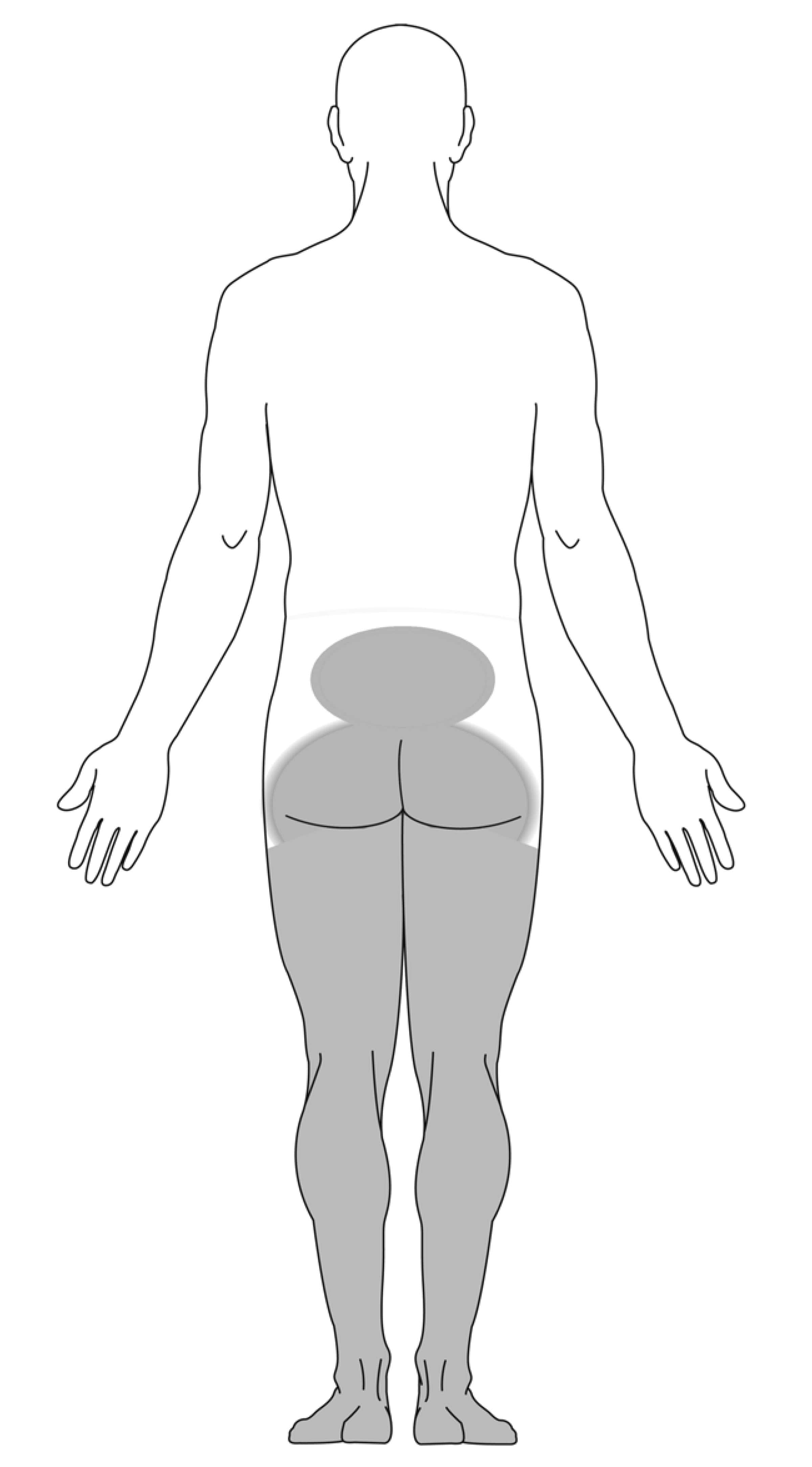 pain diagram for cauda equina syndrome