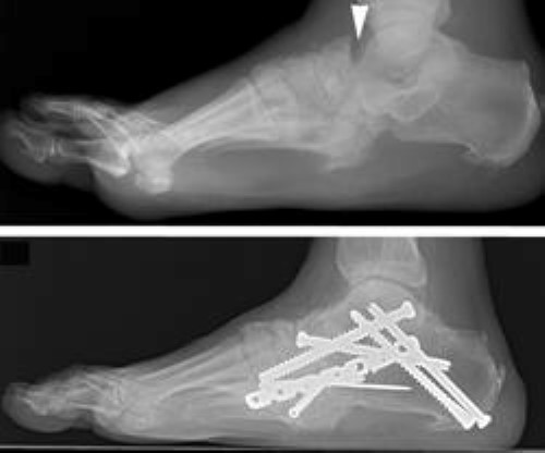 x-ray of surgery for charcot of hindfoot