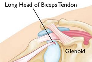 Biceps tendon tear