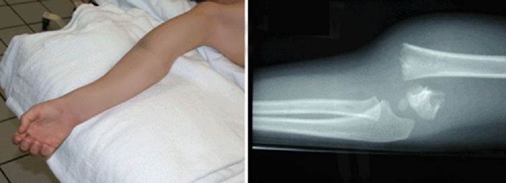 Displaced elbow fracture