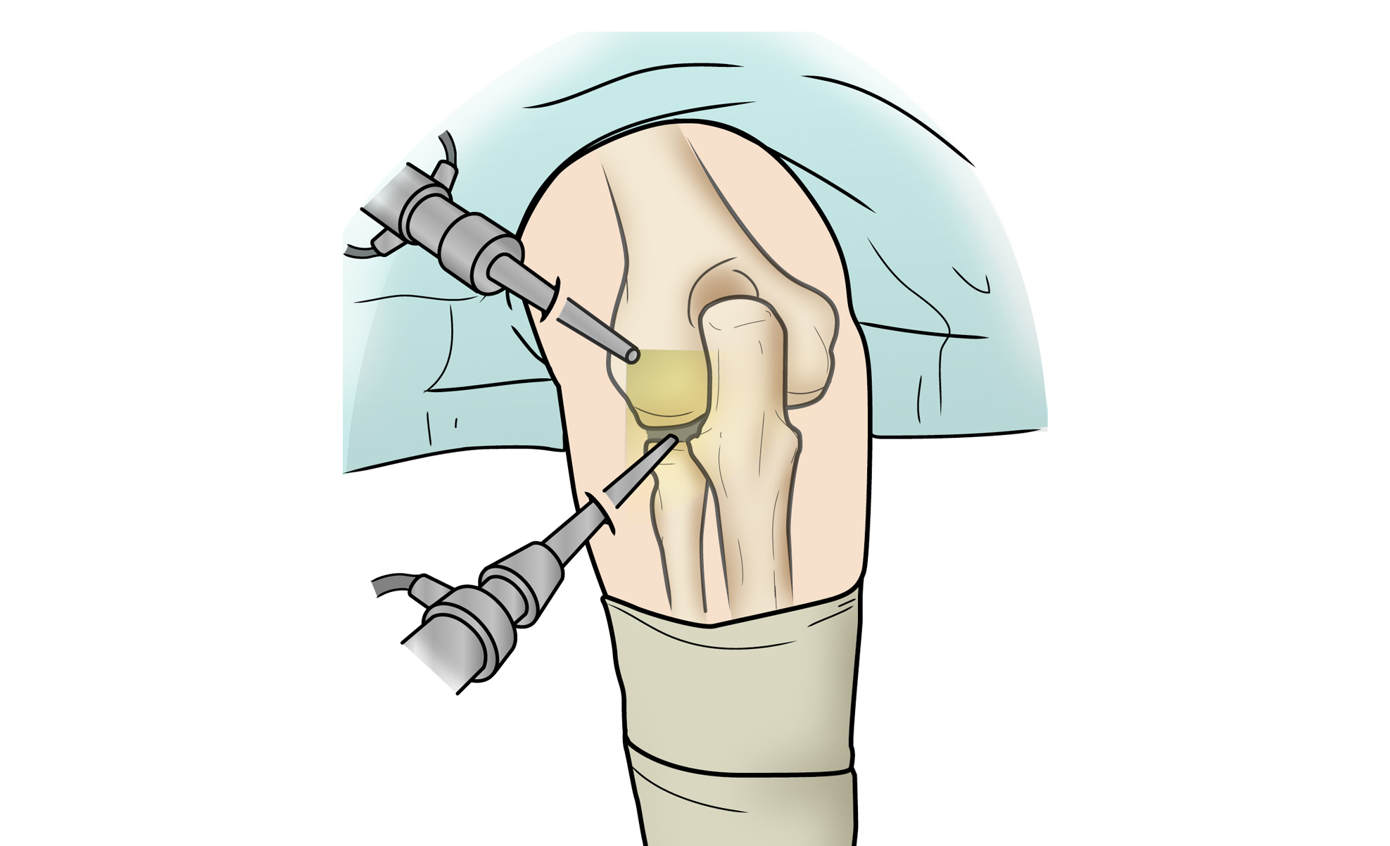 Elbow Arthroscopy Illustration