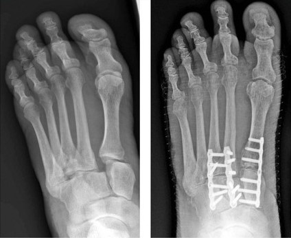Fusion for Lisfranc Fracture
