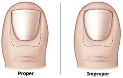 Proper and improper toenail trimming