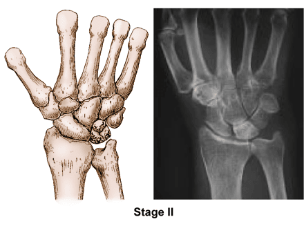 Kienböck's disease stage 2