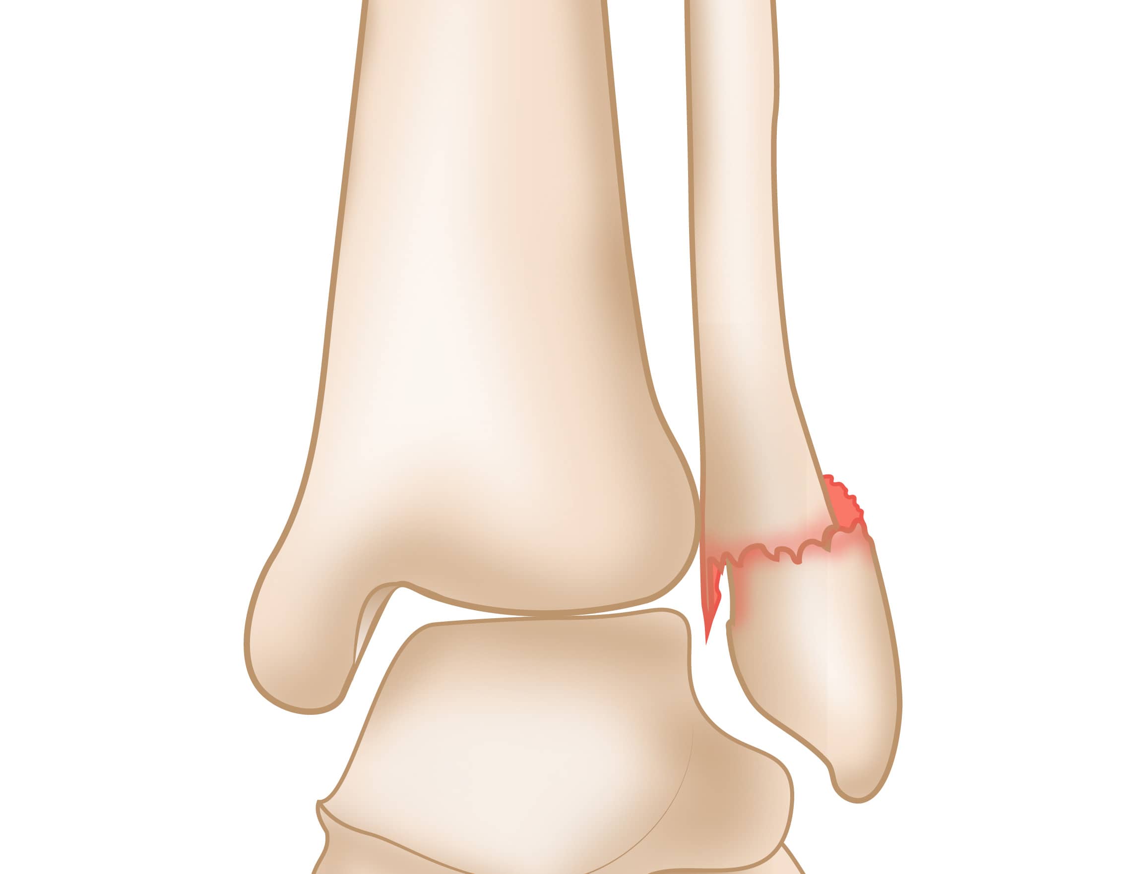 Displaced Lateral Malleolus Fracture