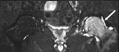 MRI scan showing edema