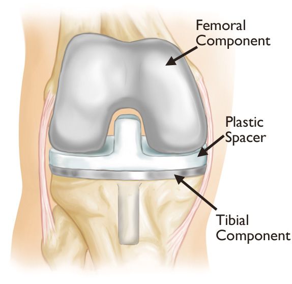 total knee replacement implants