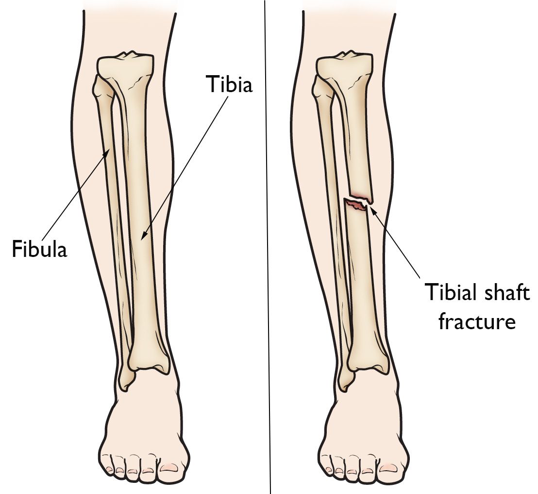 Lower leg anatomy and tibial shaft fracture