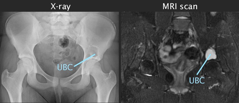 X-ray and MRI scan of unicameral bone cyst