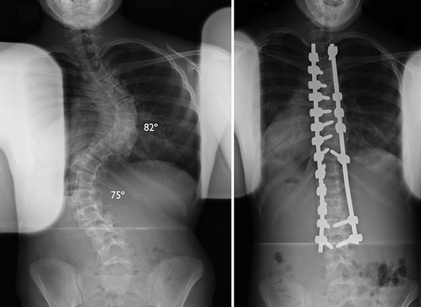 X-rays of a scoliosis curve before and after spinal fusion