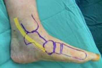 Location of posterior tibial tendon