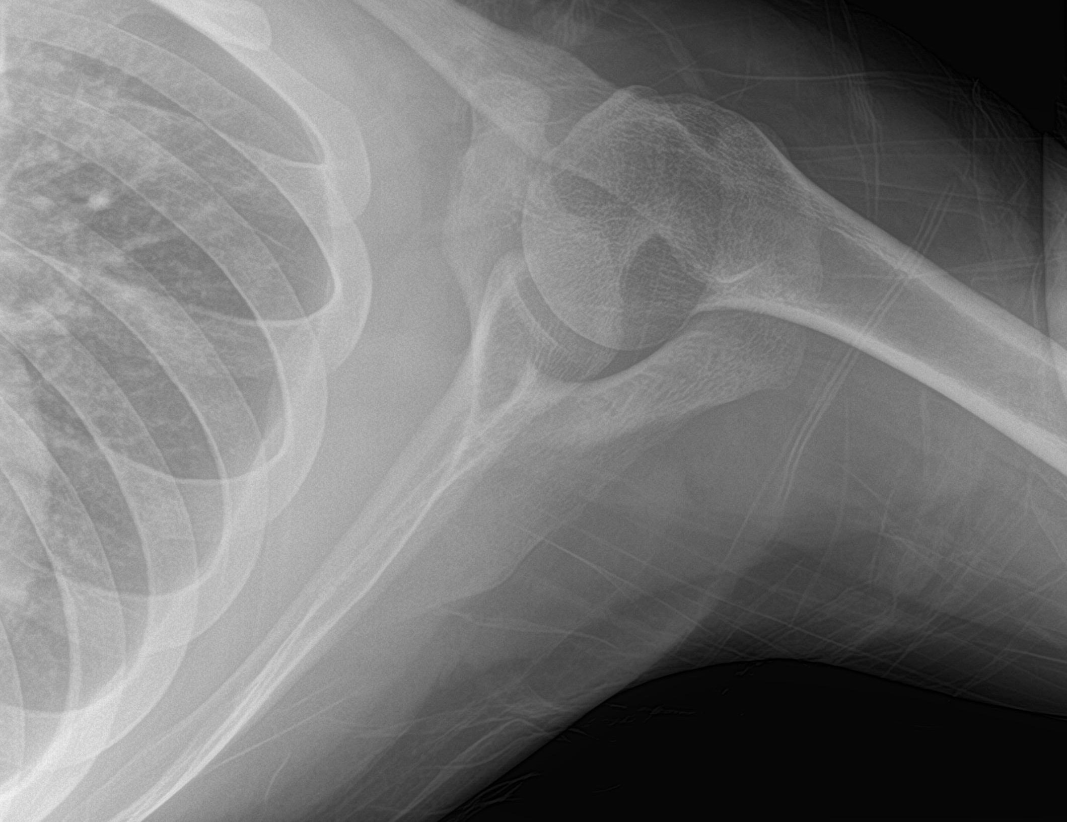 X-ray of Dislocated Shoulder After Reduction