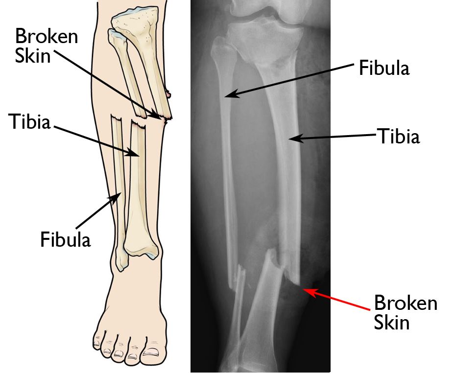 An open fracture