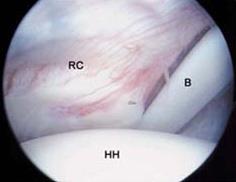 Arthroscopic view of shoulder joint