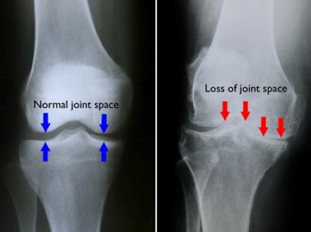 normal joint space and loss of joint space