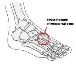 Stress fracture of metatarsal bone in foot