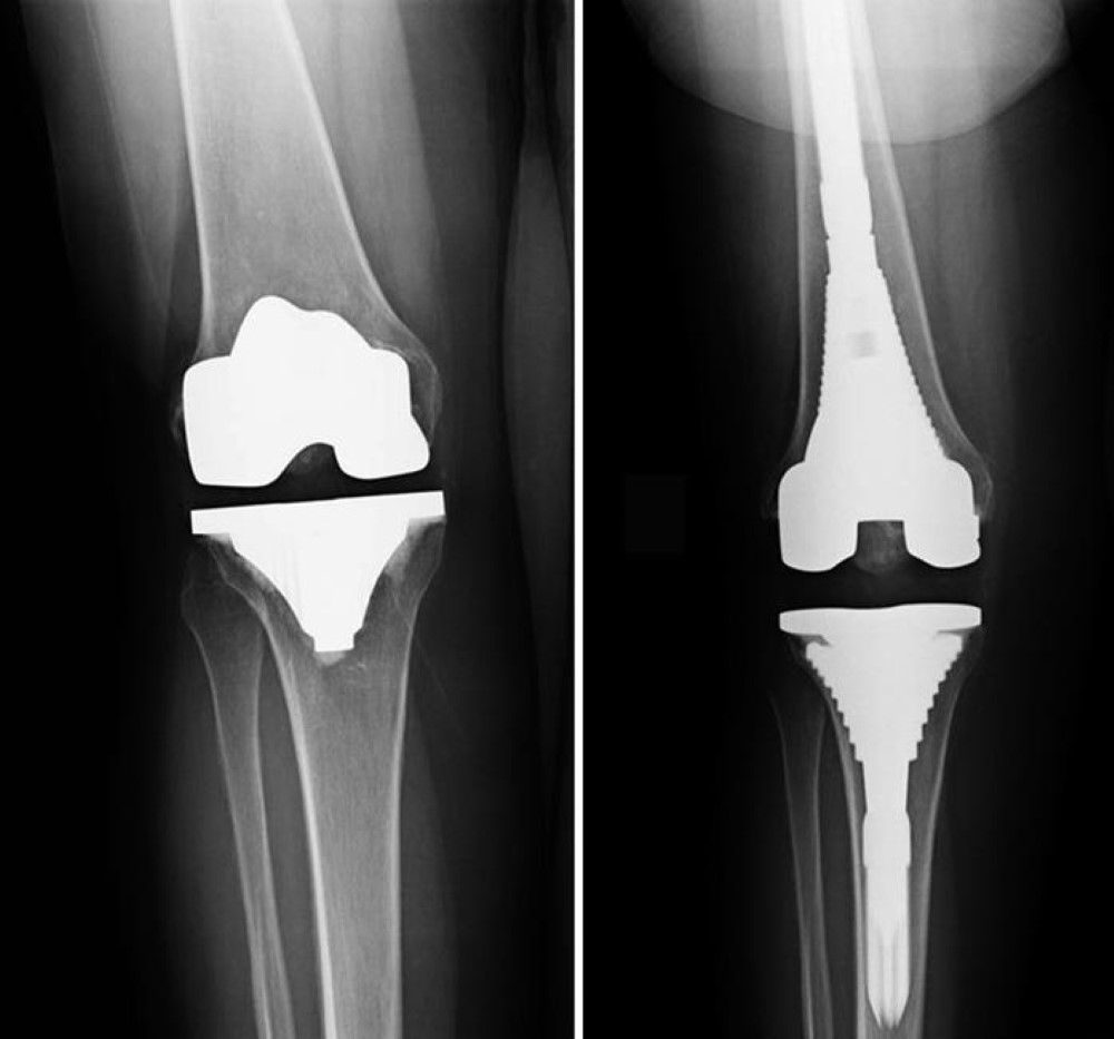 x-ray of loose knee implant and revision components