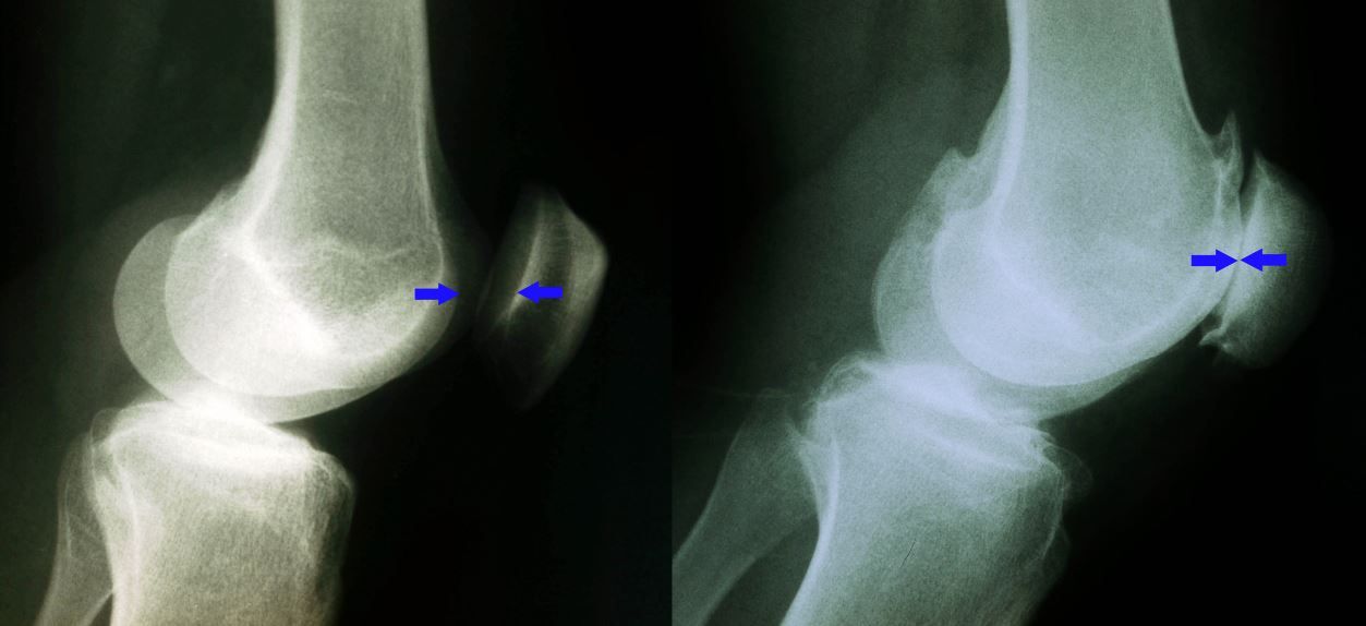 X-rays of a normal knee and an arthritic knee