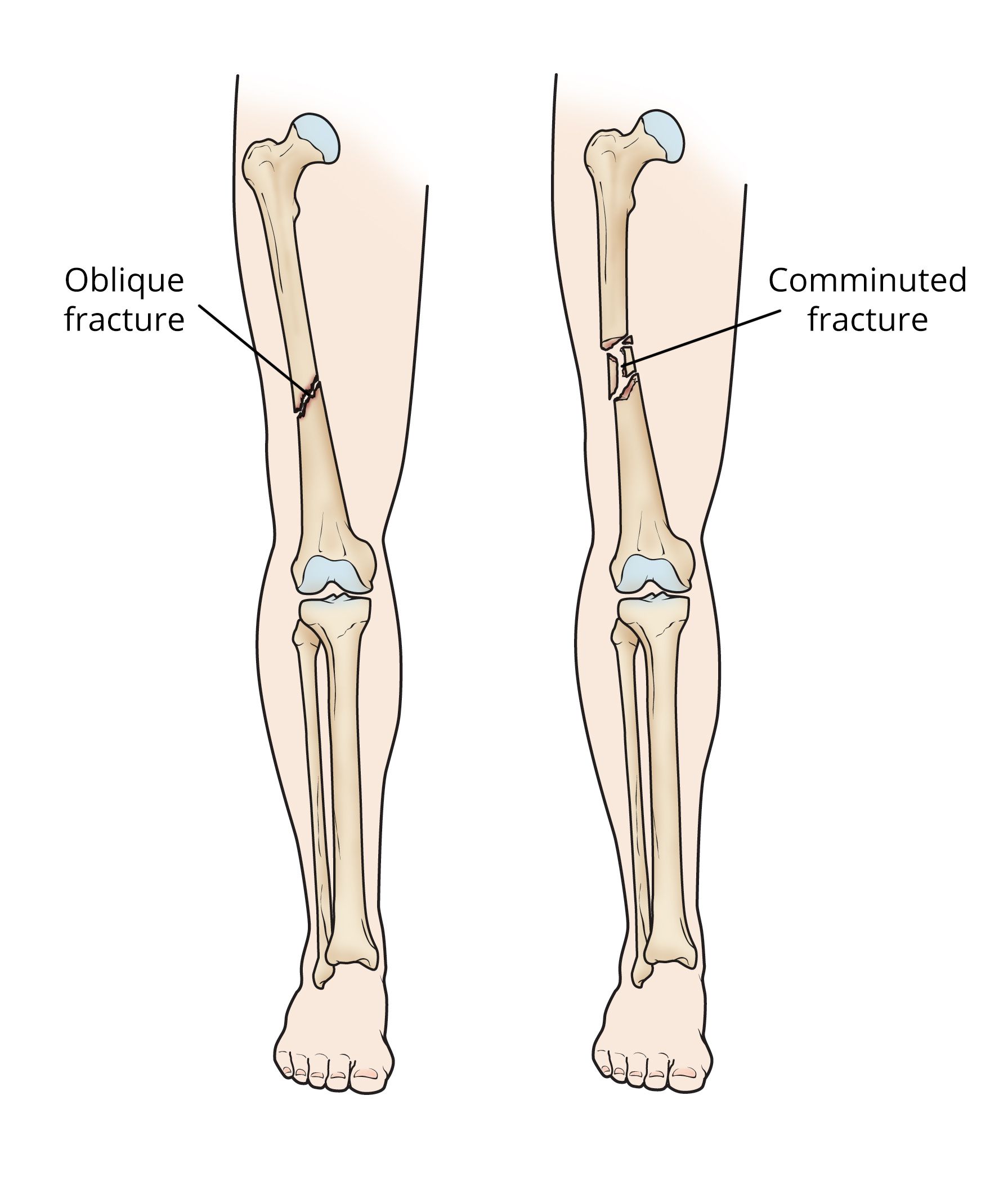 Oblique and comminuted femoral shaft fractures