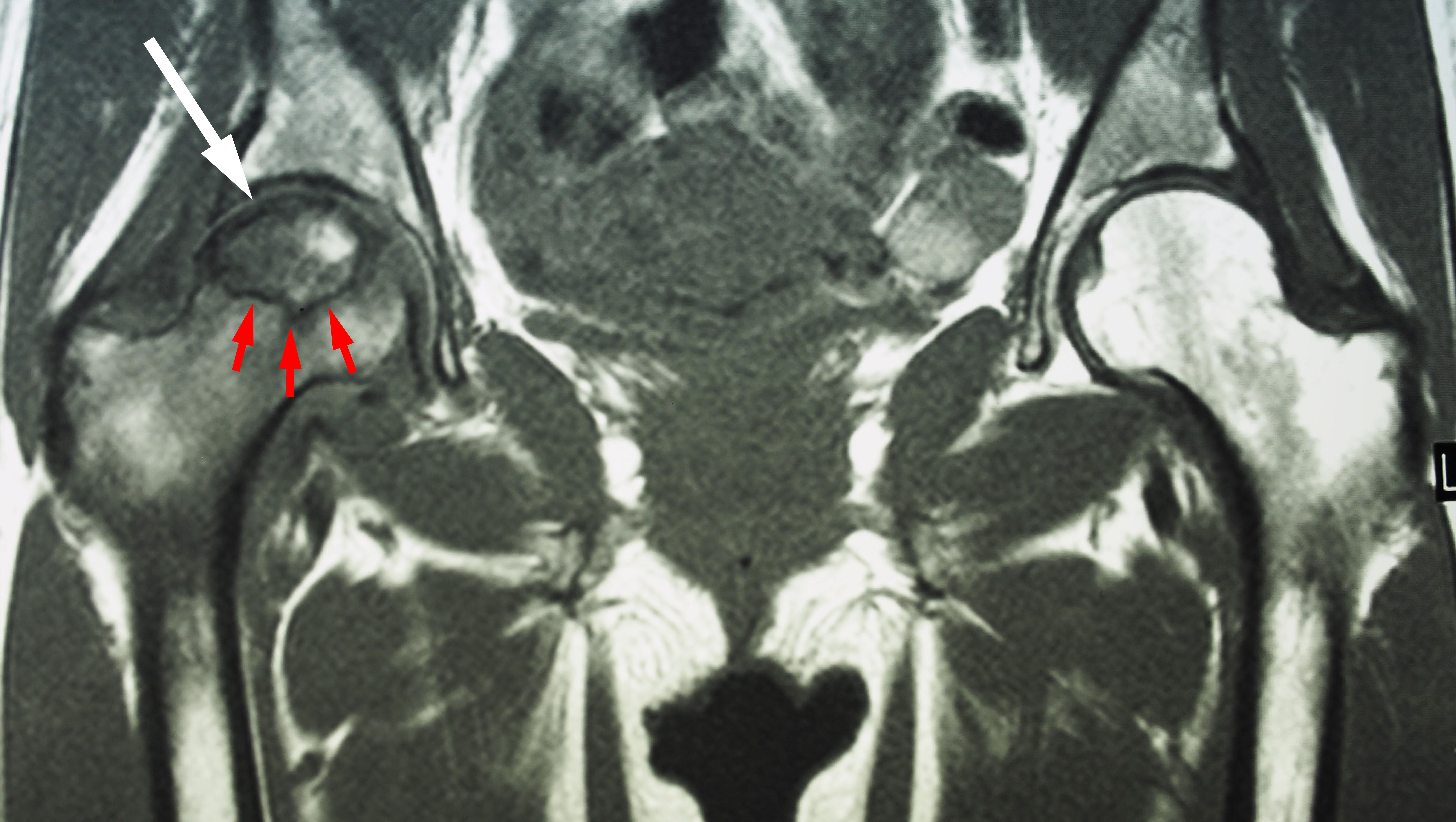 MRI of osteonecrosis
