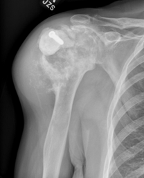 Chondrosarcoma - OrthoInfo - AAOS