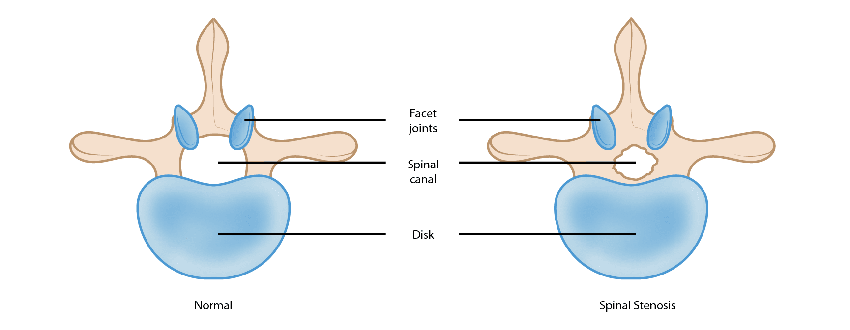 Illustrations of a healthy vertebra and a vertebra with stenosis