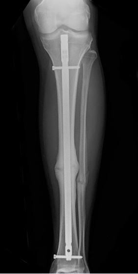Shinbone fracture treated with intramedullary nailing 