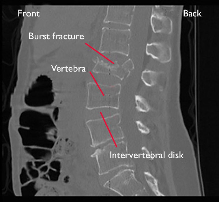 CT scan of a burst fracture in the lumbar spine