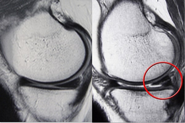 normal meniscus and meniscus tear